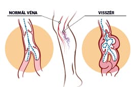 Ma már egyszerűen kezelhető probléma az is, ha a vénás tágulatok nagyobb eret vagy ereket érintenek.